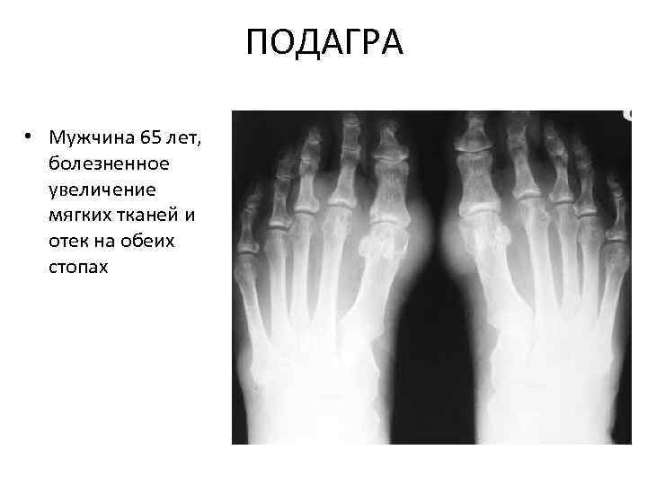 ПОДАГРА • Мужчина 65 лет, болезненное увеличение мягких тканей и отек на обеих стопах