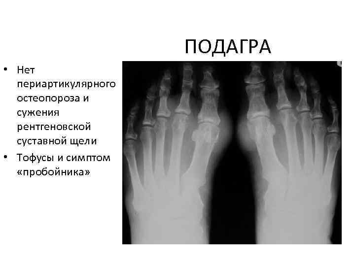 Рентген картина при подагре