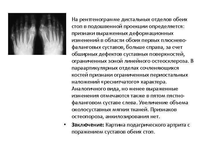  • На рентгенограмме дистальных отделов обеих стоп в подошвенной проекции определяется: признаки выраженных