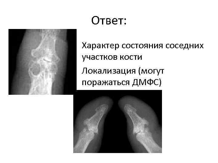 Ответ: • Характер состояния соседних участков кости • Локализация (могут поражаться ДМФС) 
