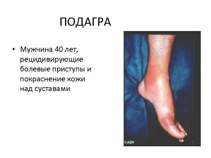 ПОДАГРА • Мужчина 40 лет, рецидивирующие болевые приступы и покраснение кожи над суставами 