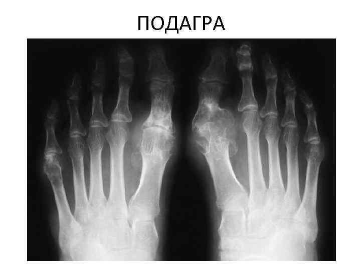 Подагрический артрит картинки