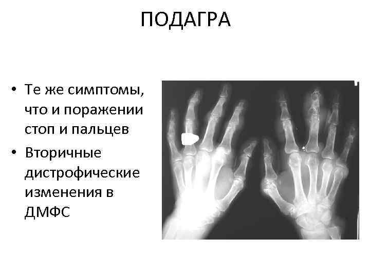 Подагра признаки у женщин. Фенотипическое проявление подагры.