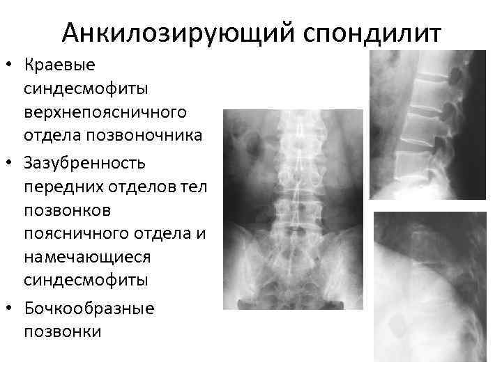  Анкилозирующий спондилит • Краевые  синдесмофиты  верхнепоясничного  отдела позвоночника • Зазубренность