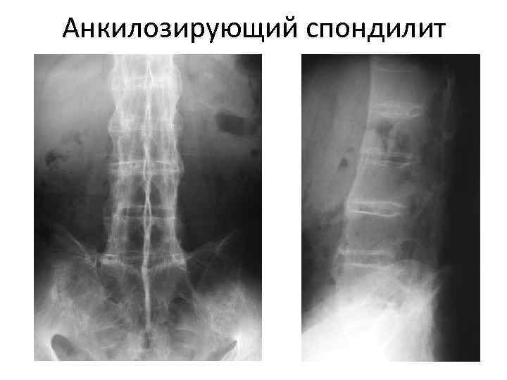 Анкилозирующий спондилоартрит презентация