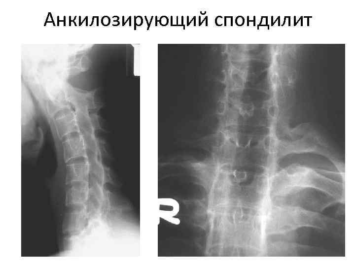 Анкилозирующий спондилоартрит презентация