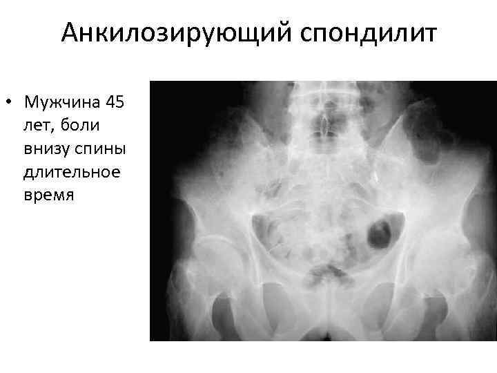 Анкилозирующий спондилоартрит презентация