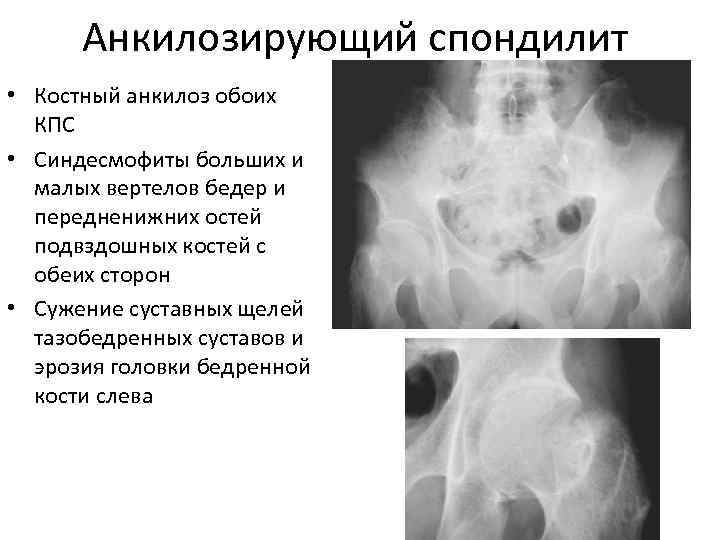  Анкилозирующий спондилит • Костный анкилоз обоих  КПС • Синдесмофиты больших и 