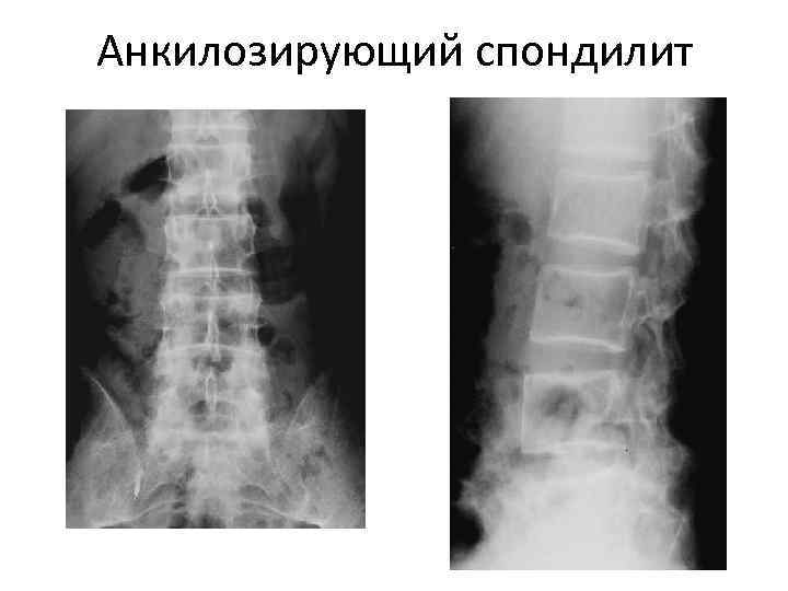 Анкилозирующий спондилит 