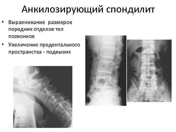 Анкилозирующий спондилоартрит презентация