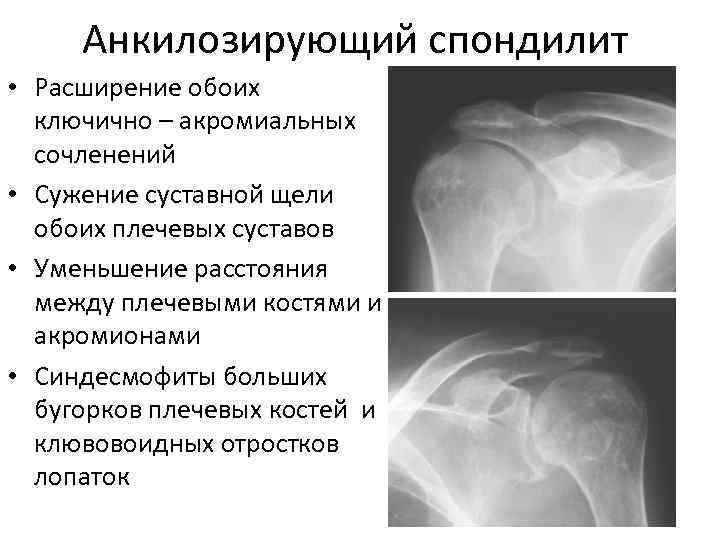  Анкилозирующий спондилит • Расширение обоих  ключично – акромиальных  сочленений • Сужение