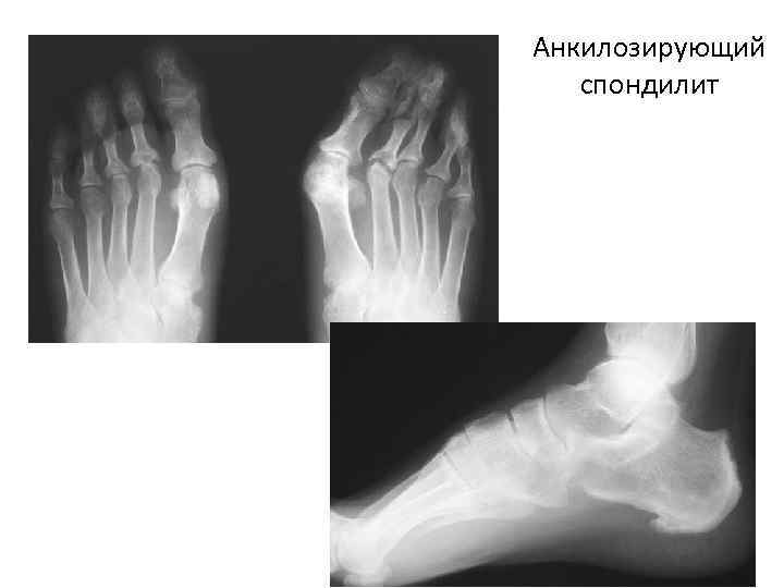 Анкилозирующий спондилоартрит презентация