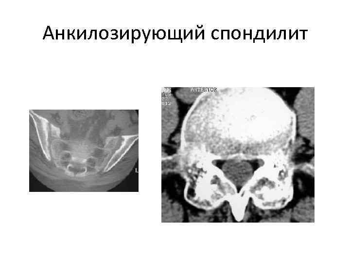 Анкилозирующий спондилит 