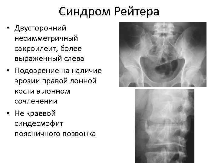   Синдром Рейтера • Двусторонний  несимметричный  сакроилеит, более  выраженный слева