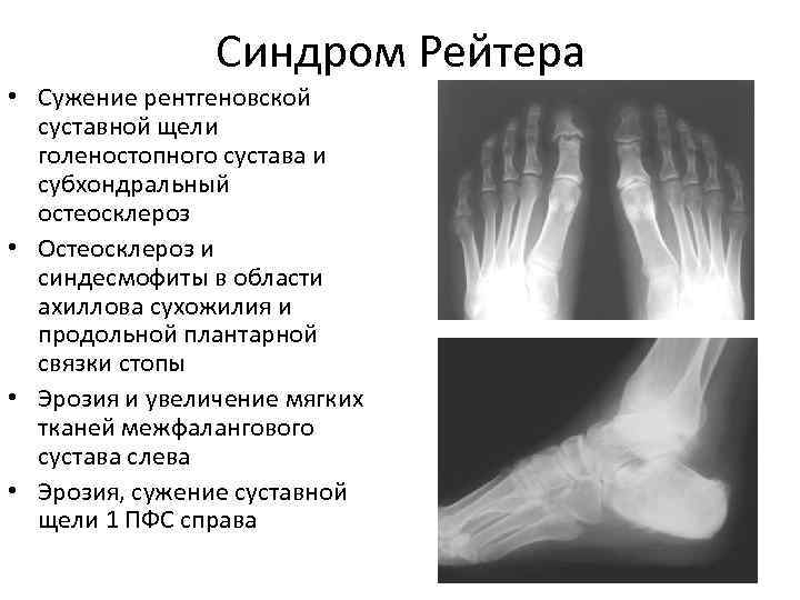 Клиническая картина синдром рейтера