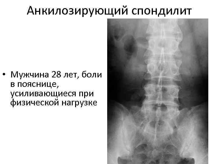  Анкилозирующий спондилит • Мужчина 28 лет, боли  в пояснице,  усиливающиеся при