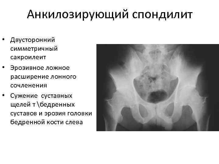   Анкилозирующий спондилит • Двусторонний  симметричный  сакроилеит • Эрозивное ложное 