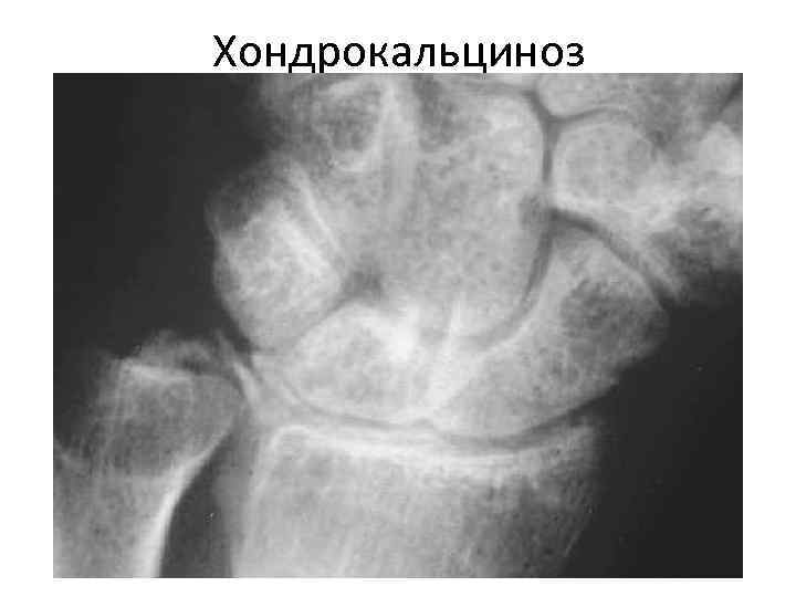 Хондрокальциноз 