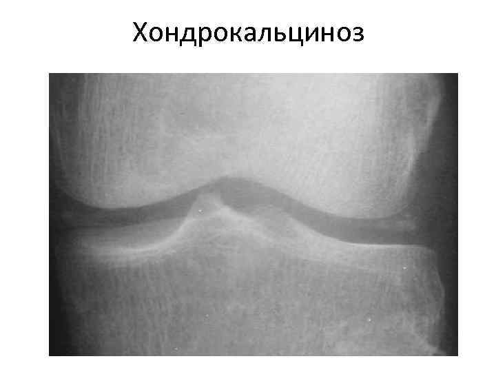 Хондрокальциноз 