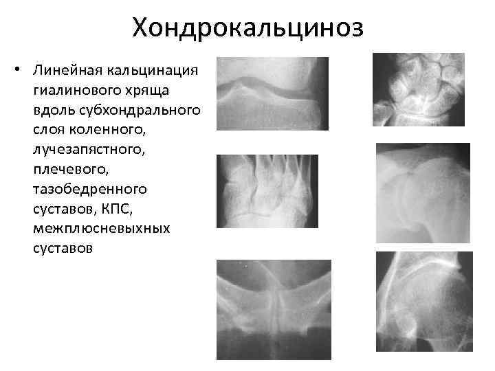 Хондрокальциноз • Линейная кальцинация гиалинового хряща вдоль субхондрального слоя коленного, лучезапястного, плечевого, тазобедренного суставов,