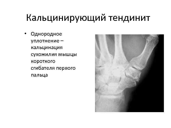 Кальцинирующий тендинит • Однородное уплотнение – кальцинация сухожилия мышцы короткого сгибателя первого пальца 