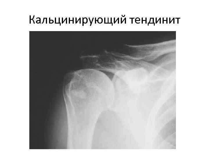 Кальцинирующий тендинит 