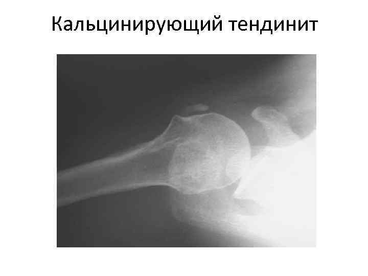 Кальцинирующий тендинит 