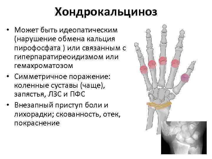 Хондрокальциноз • Может быть идеопатическим (нарушение обмена кальция пирофосфата ) или связанным с гиперпаратиреоидизмом