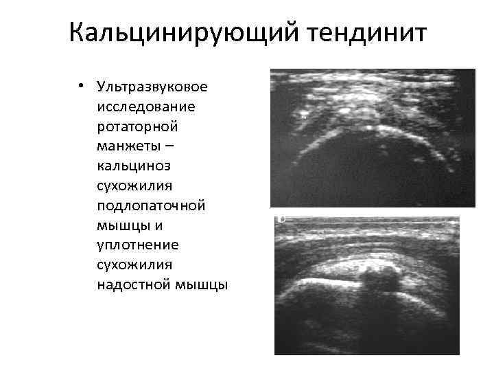 Кальцинирующий тендинит • Ультразвуковое исследование ротаторной манжеты – кальциноз сухожилия подлопаточной мышцы и уплотнение