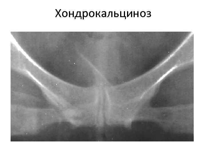 Хондрокальциноз 