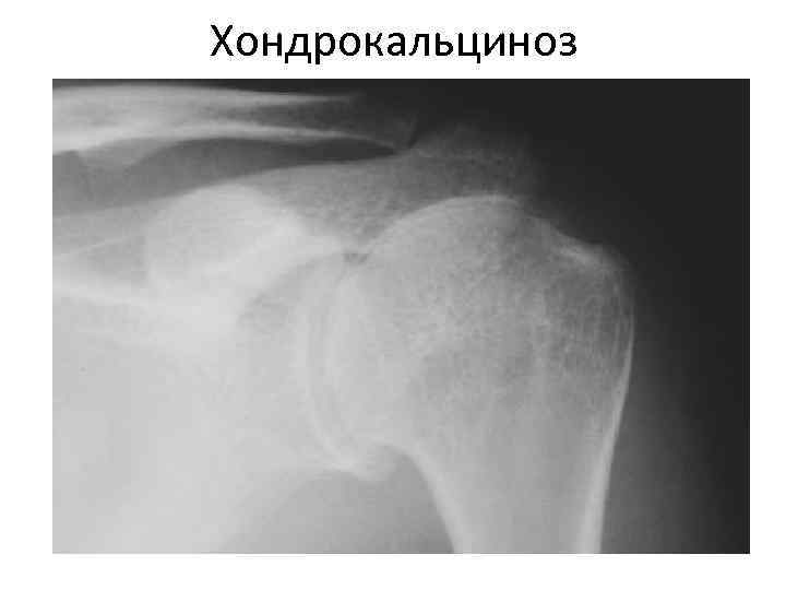 Хондрокальциноз 