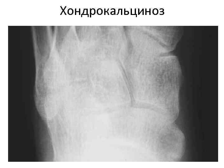Хондрокальциноз 
