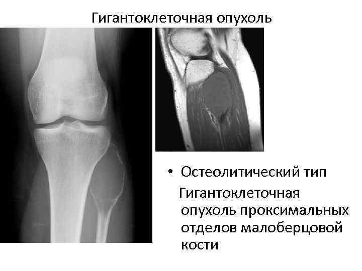 Для рентгенологической картины ячеистой формы гигантоклеточной опухоли характерно