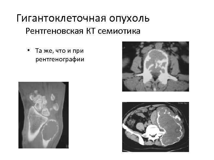 Рентгенологическая картина гигантоклеточной опухоли характеризуется разновидностями