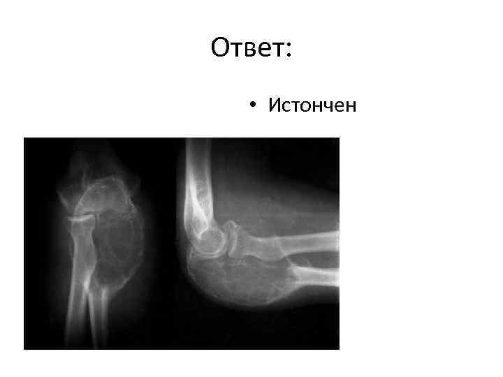 Ответ: • Истончен 
