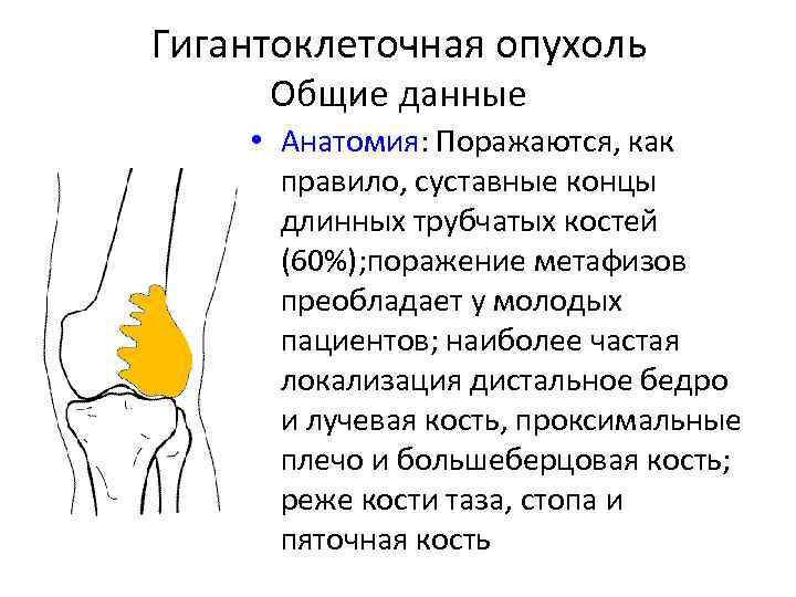 Гигантоклеточная опухоль Общие данные • Анатомия: Поражаются, как правило, суставные концы длинных трубчатых костей