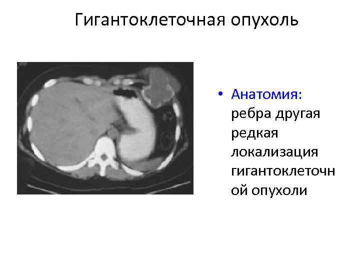 Гигантоклеточная опухоль • Анатомия: ребра другая редкая локализация гигантоклеточн ой опухоли 
