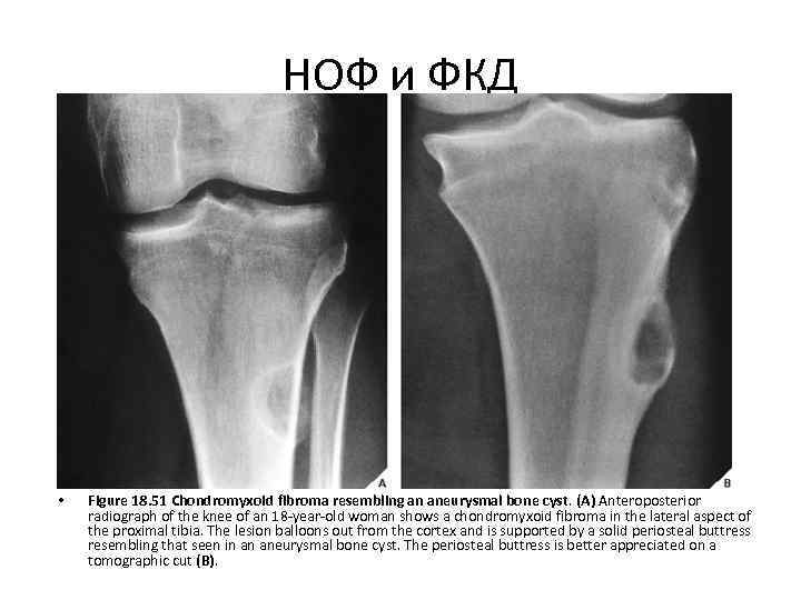 Фиброзная дисплазия большеберцовой кости