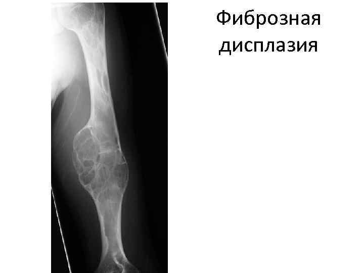 Фиброзная дисплазия 