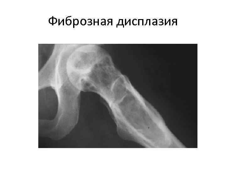Фиброзная дисплазия 