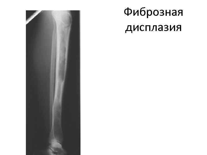 Фиброзная дисплазия. Фиброзная дисплазия большеберцовой кт. Фиброзная дисплазия большеберцовой кости рентген. Фиброзная дисплазия (избирательная, одной кости). Фиброзно кистозная дисплазия плечевой кости.