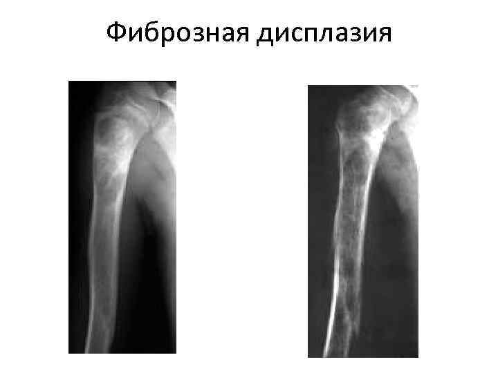 Фиброзная дисплазия 