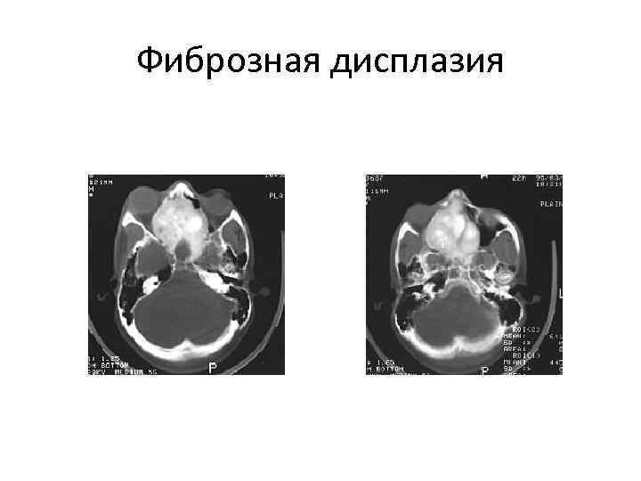 Фиброзная дисплазия 