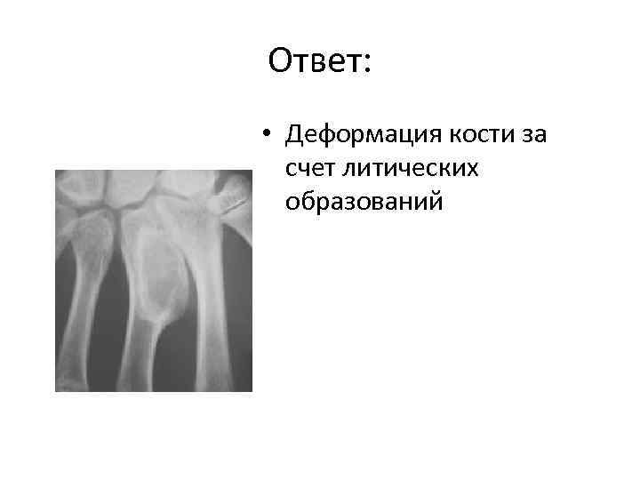 Ответ: • Деформация кости за счет литических образований 