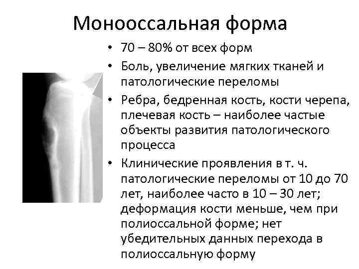 Монооссальная форма • 70 – 80% от всех форм • Боль, увеличение мягких тканей