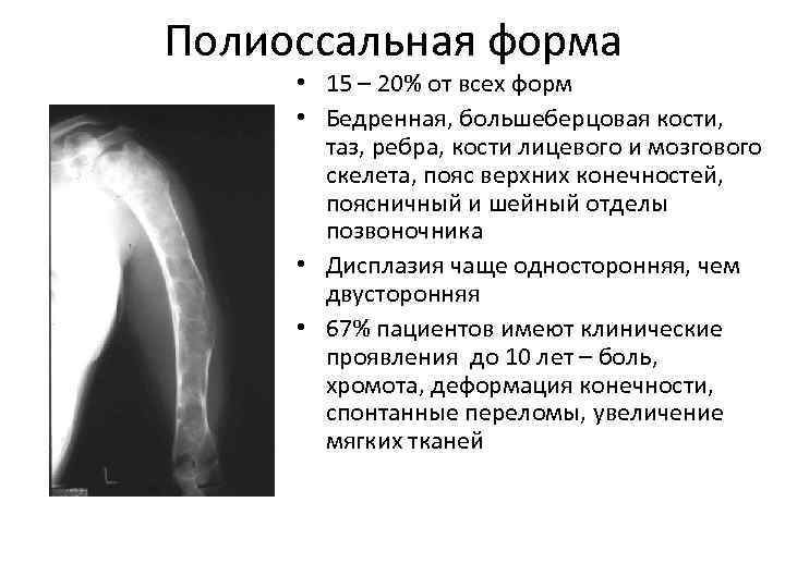 Полиоссальная форма • 15 – 20% от всех форм • Бедренная, большеберцовая кости, таз,