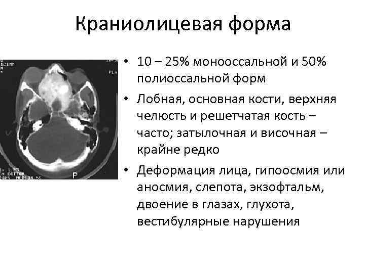 Краниолицевая форма • 10 – 25% монооссальной и 50% полиоссальной форм • Лобная, основная