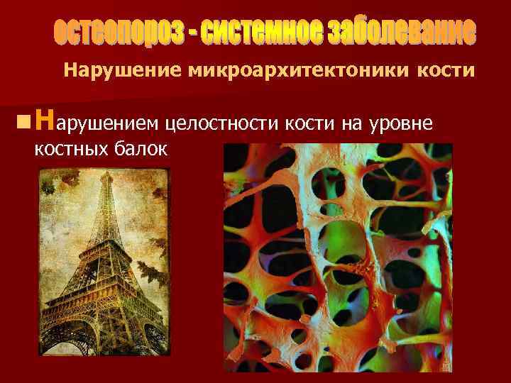 Нарушение микроархитектоники кости n Нарушением целостности кости на уровне костных балок 