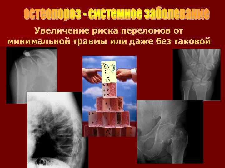 Увеличение риска переломов от минимальной травмы или даже без таковой 