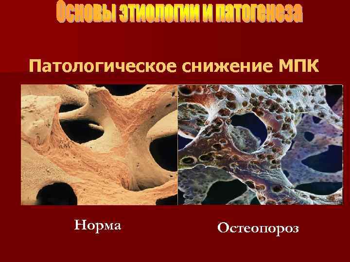 Патологическое снижение МПК Норма Остеопороз 